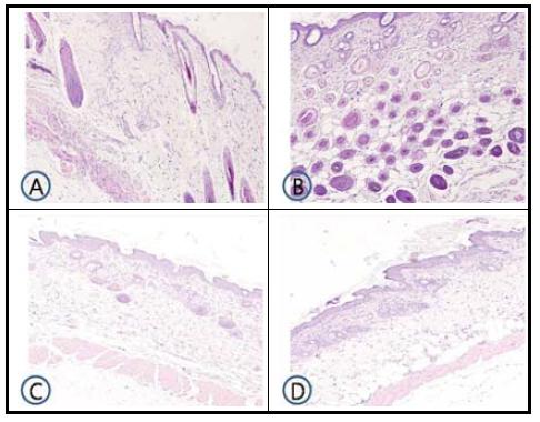 Histologic examination of dorsal skin lesion in TNCB-induced NC/Nga mice.