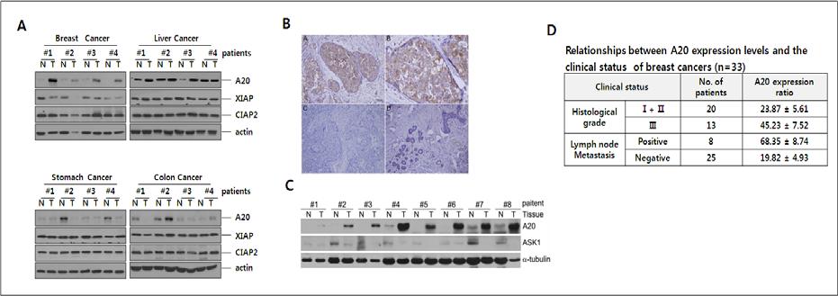유방암에서 A20 과발현 및 유방암환자 암화정도에 따른 발현률 비교