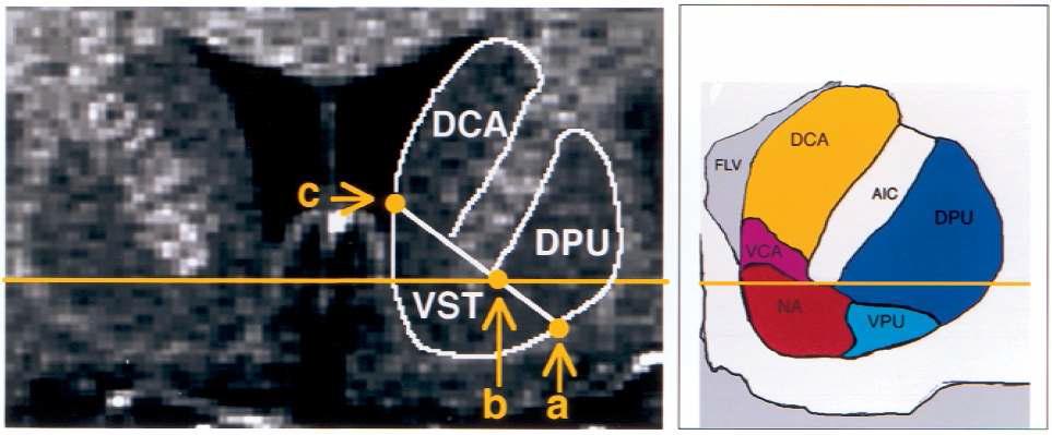 Defining ROIs: dorsal caudate(DCA), dorsal putamen(DPU), ventral striatum(VST). 개별 피험자의 구조영 상에서 설정함.