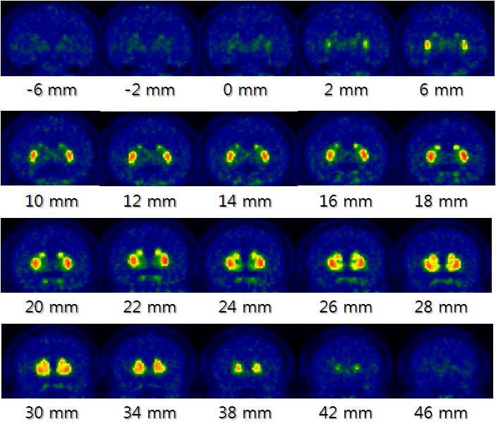 PET images illustrating ligand binding in the bilateral striatum