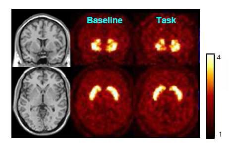 Parametric images of binding potentials during baseline and online task from an individual subject