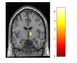 Illustration of the right striatum releasing more dopamine during task performance compared to the baseline