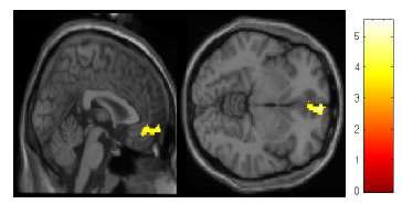 Illustration of the orbitofrontal cortex region releasing more dopamine during task performance compared to the baseline