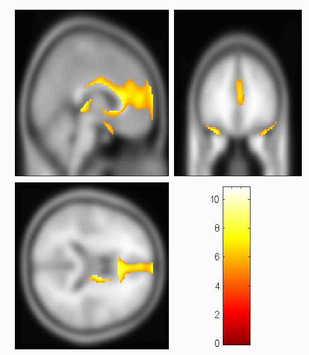 Brain map illustrating greater metabolism in the medial prefrontal regions in young people compared to older people