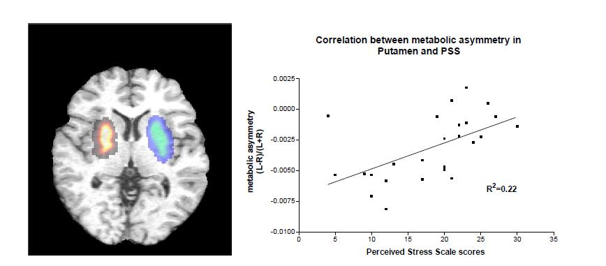 llustrating the location of the putamen and positive correlation between right sided metabolic bias and stress perception