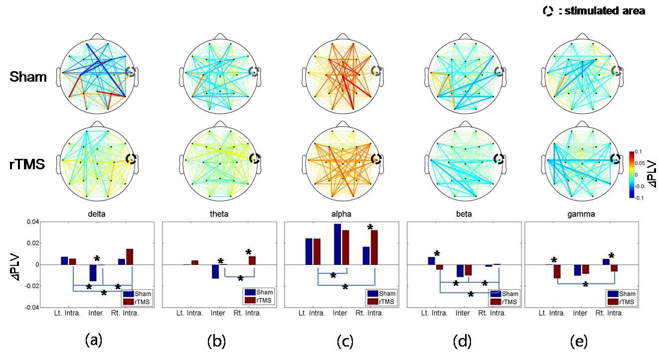 PLV change patterns and lateralization. Top panels: PLV change patterns for sham stimuli. Middle panels: PLV change patterns for real rTMS. ΔPLV value between all possible electrodes pairs were depicted by colored lines and line width. Lower panels: averaged values of ΔPLV for each region and condition. (a)-(e) ordering correspto delta, theta, alpha, beta, and gamma. In top and middle panels, back dots depict channel position and dashed black circle mean the position of stimuli. In bottom panels, ‘Lt. Intra’, ‘Inter’, and ‘Rt. Intra’ correspond to left intrahemisphere, interhemisphere, and right intrahemiphere respectively and asterisk (*) means significant differences.