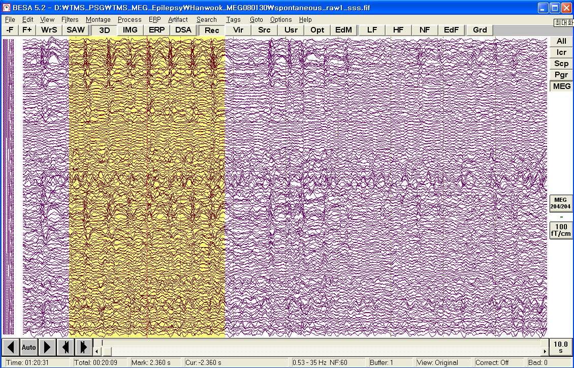 306 channels whole-head MEG sequence from a left frontal lobe epilepsy patient. Several inter-ictal spikes were observed in left fronto-temporal area.