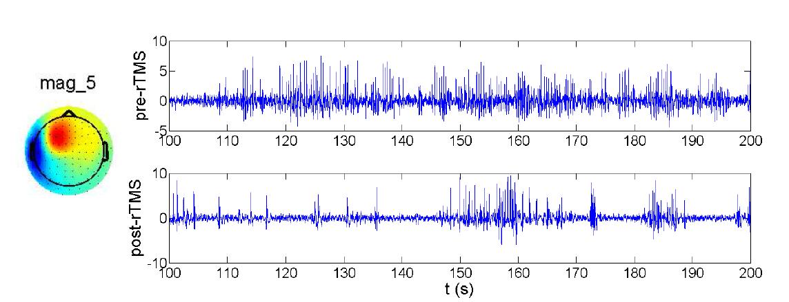 Source activities of independent component for inter-ictal spike generation.