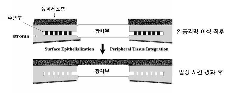 제조된 인공각막의 최종 응용 예