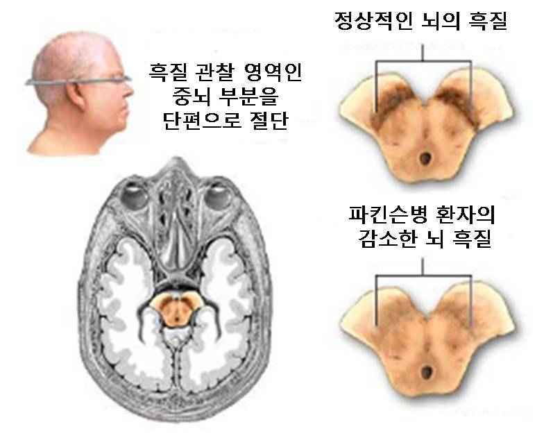 흑질의 감소를 보이는 파킨슨병 환자의 뇌