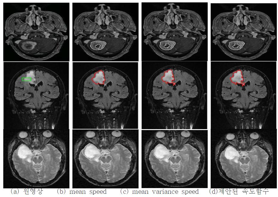 실제 뇌 영상의 종양 분할 결과