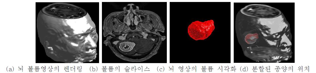 실제 뇌 영상 슬라이스의 볼륨과 분할된 종양의 시각화