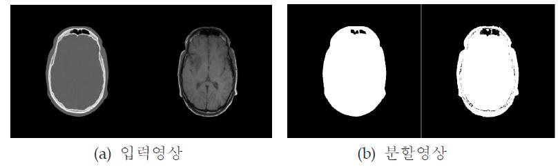 CT(왼쪽)과 MR(오른쪽)의 MRF-ICM을 이용한 분할결과