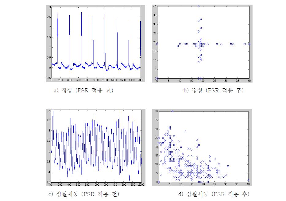 Time-Delay Methods(PSR) 적용 전후 정상파형과 심실세동의 예