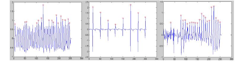 정상, VT, VF ECG 신호의 웨이블릿 변환 및 피크 추출