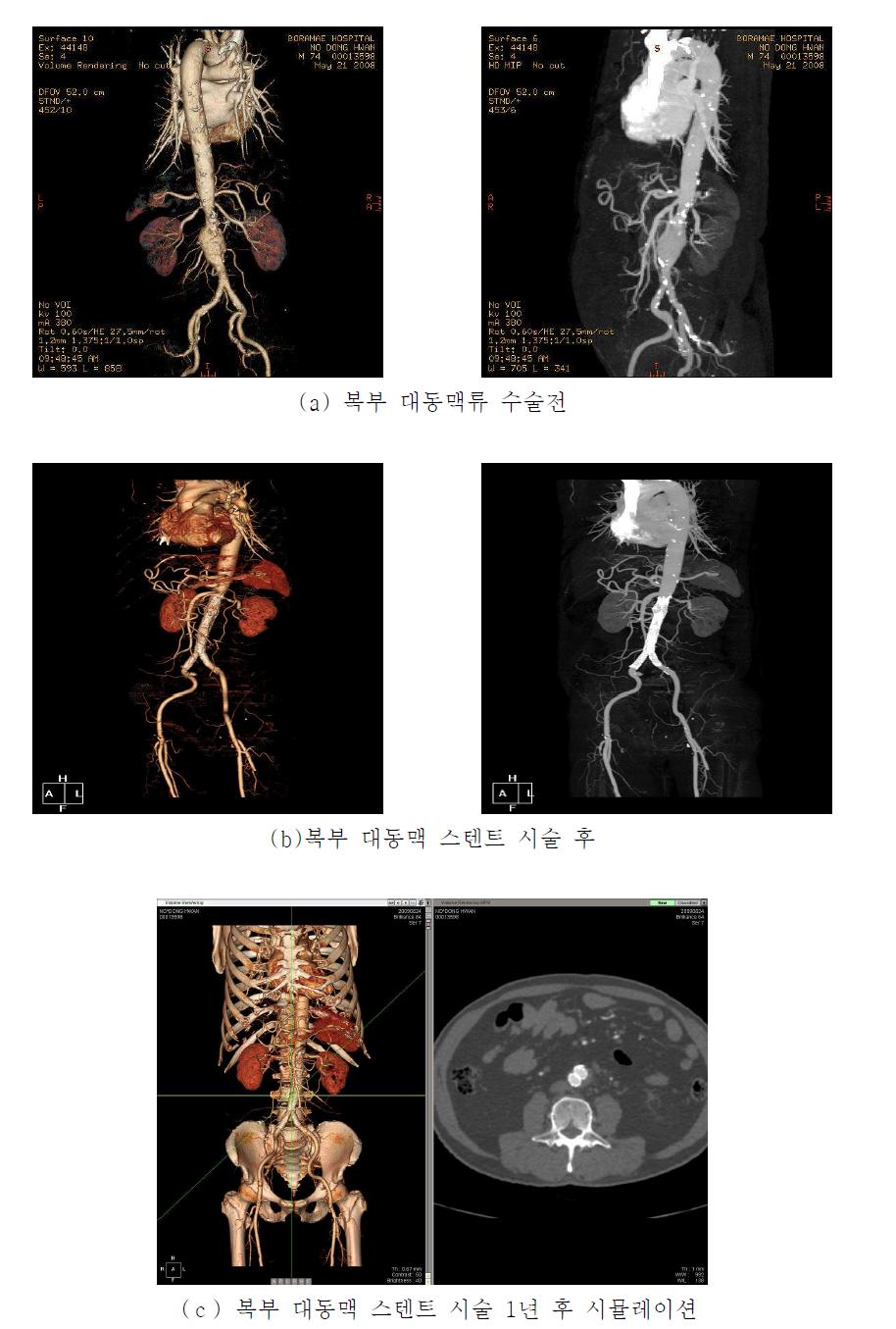 복부 대동맥의 병리적 상황에서의 시뮬레이션