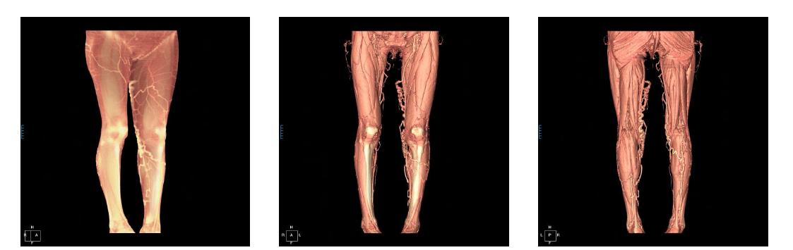 하지 정맥류 3차원 CT 영상