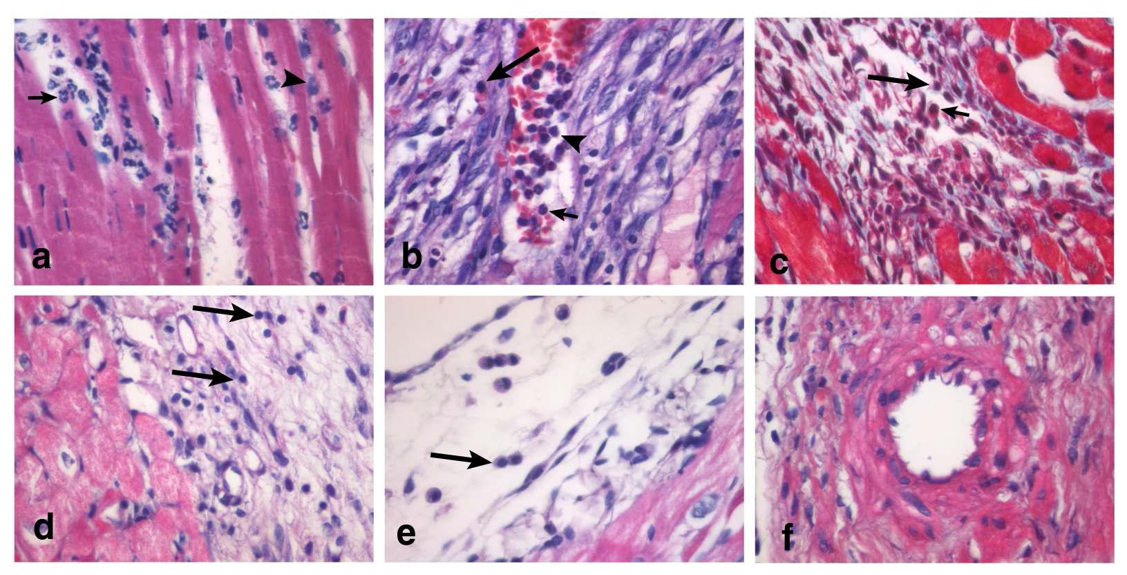 Distribution of Neutrophil (short arrows), Macrophage (arrow heads), Lymphocyte (long arrows), Myofibroblast and collagen at the site of 1 day (a), 3 days (b), 5 days (c), 7 days (d) 14 days (e) and 30 days (f) after MI. (H-E stain × 400).