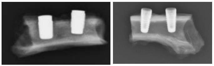 X-ray images for buffered implant(left) & screw implant(right)