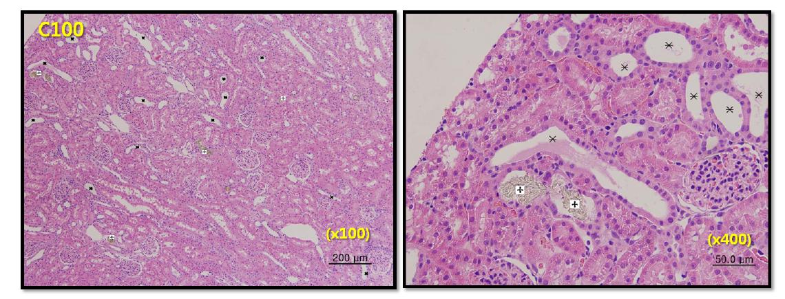 Renal histologic diagnosis in male SD rats following 7-day repeated oral texposure to cyanuric acid at 100 mg/kg/day.