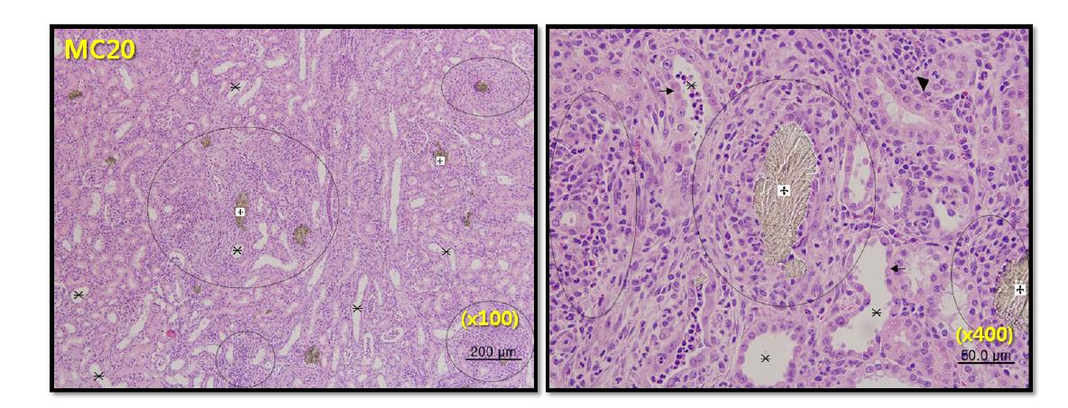 Renal histologic diagnosis in male SD rats following 7-day repeated oral exposure to melamine-cyanuric acid mixture at 20 mg/kg/day.