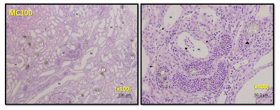 Renal histologic diagnosis in male SD rats following 7-day repeated oral exposure to melamine-cyanuric acid mixture at 100 mg/kg/day.