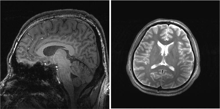 Multi-channel Tx/Rx coil을 사용하여 획득한 영상 왼쪽: MP-RAGE 영상 오른쪽: Turbo spin echo 영상