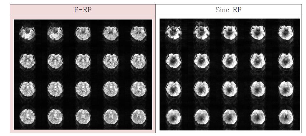 초고자장(7.0T) Sinc RF pulse와 F-RF pulse에 대한 in-vivo 영상 (EPI 시퀀스)
