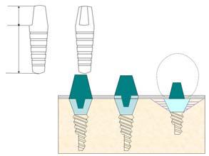 치과용 implant 설계 모식도