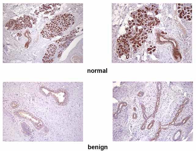 정상 유방조직 및 양성 유방암 조직에서의 NDRG2 단백질 발현