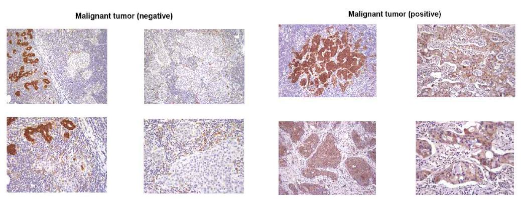 NDRG2 단백질 발현 음성 및 양성 악성 유방암 조직