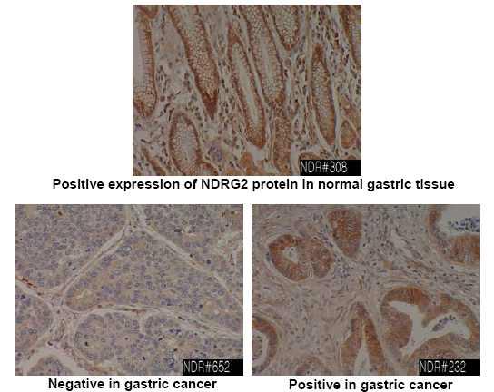 정상 위조직과 암조직에서의 NDRG2 단백질 발현 양상 (II)