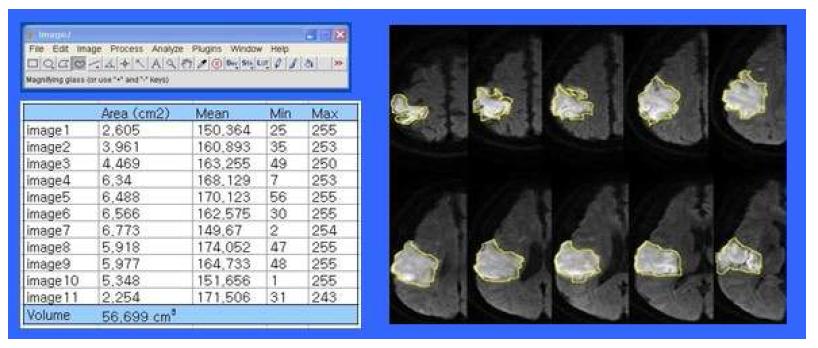 Image J 프로그램을 이용한 뇌경색의 부피측정.