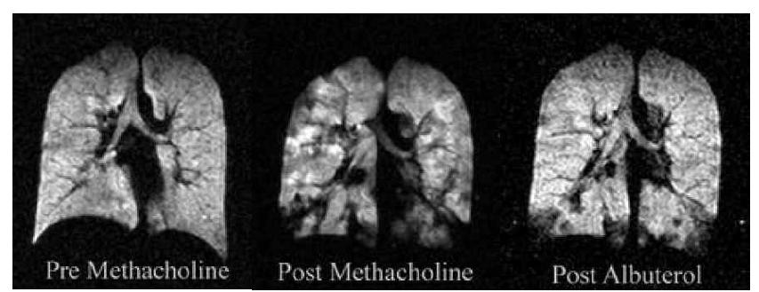 (좌) 메타콜린 (기관지 수축제) 투여전 정상 헬륨 MR 소견 (중) 메타콜린 투여후 다발성 폐환기 결손(우) 알부테롤 (기관지확장제) 투여후 다발성 환기 결손부위의 감소