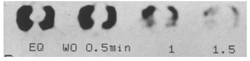 133Xe 신티그래피 SPECT 영상, 낮은 공간 해상도로 국소적 환기 이상 분석에 용이하지 않음