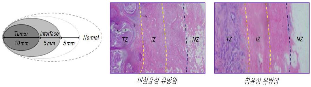 유방암 조직상의 변연부(IZ) 설정