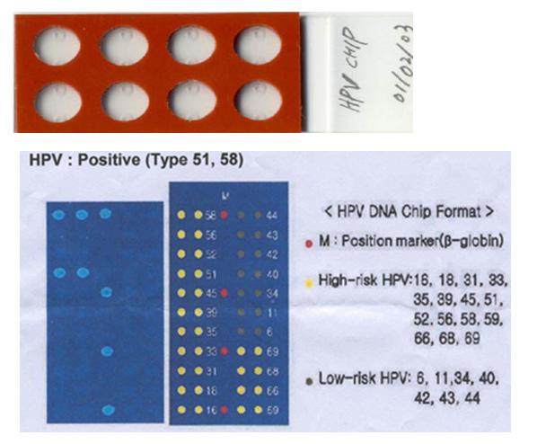 HPV DNA chip과 양성 검사결과의 예