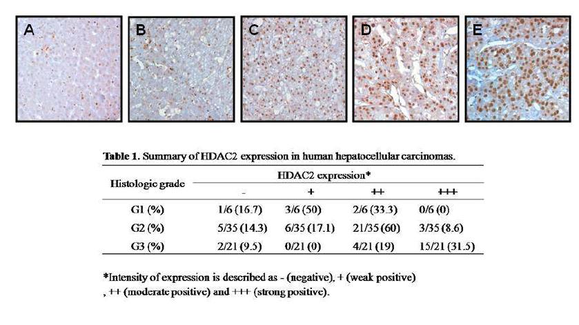 간암 진행 정도에 따른 조직 내 HDAC2 단백질 발현
