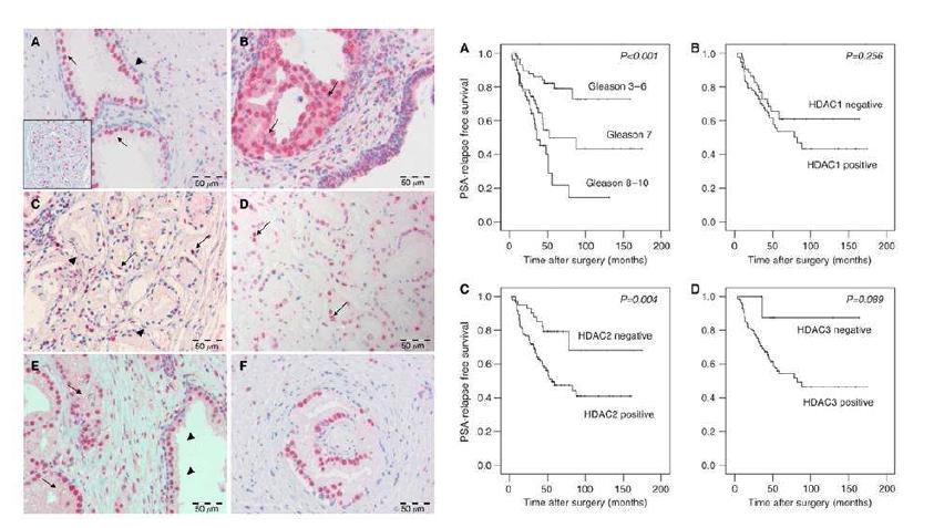전립선암과 HDAC2 유전자발현의 상관 관계