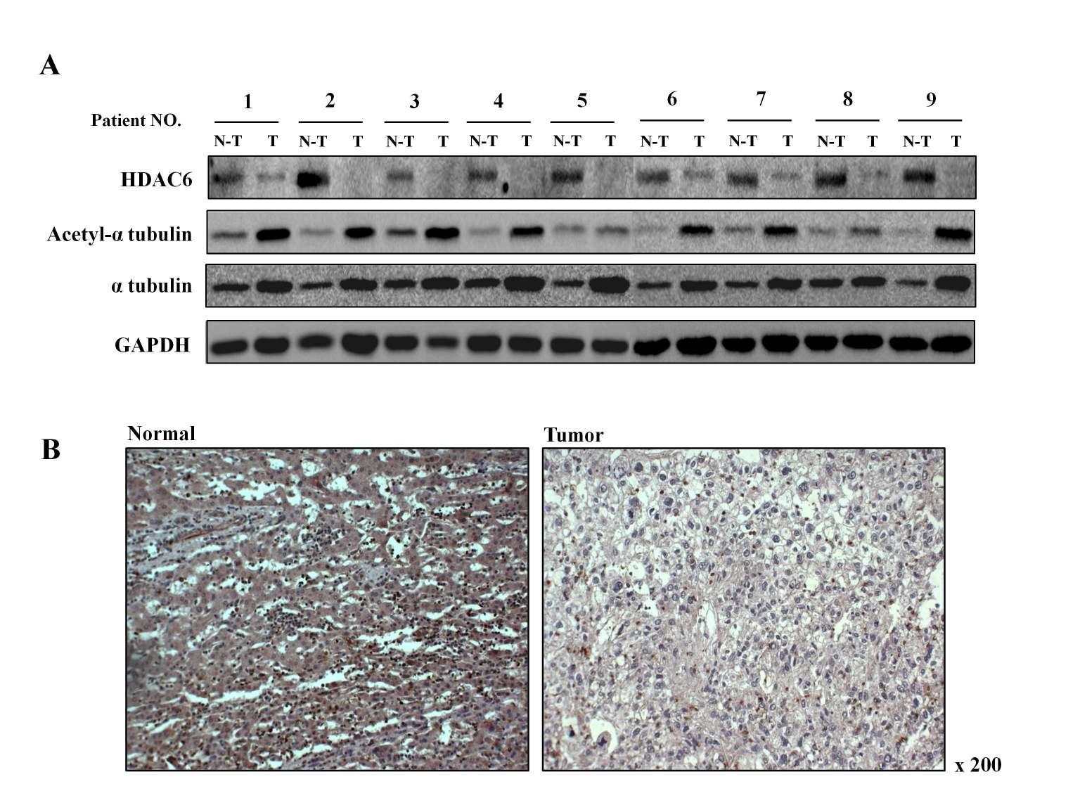 간암 검체에서의 HDAC6 단백질 발현