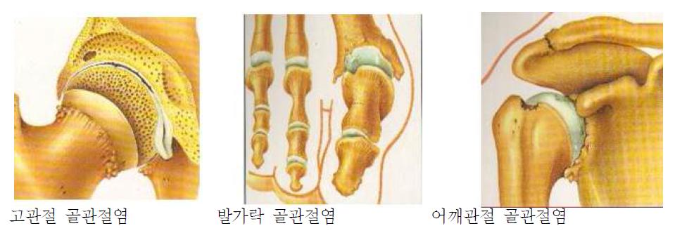 골관절염 호발 부위