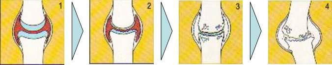 류마티스성 관절염의 진행과정