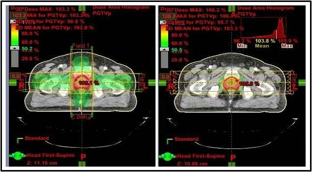 Comparing of the radiation therapy efficiency with the x-ray and proton.