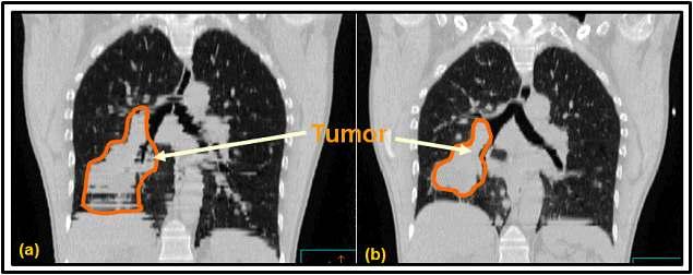 (a) Tumor target region using the general CT and (b) 4D-CT.