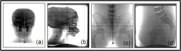 Two sets of orthogonal images of the humanoid phantom using DIPS system.