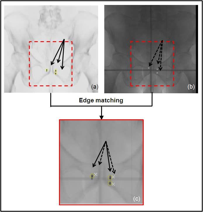 (a) An initial coronal DRR image from CT images in the planning stage. (b) A 2D x-ray image from the treatment room. The prostate target is marked by three fiducial markers. (c) Resulting image following application of the edge based automatic patient positioning system to the two images in 그림6(a) and (b), showing a mismatch in fiducial markers.