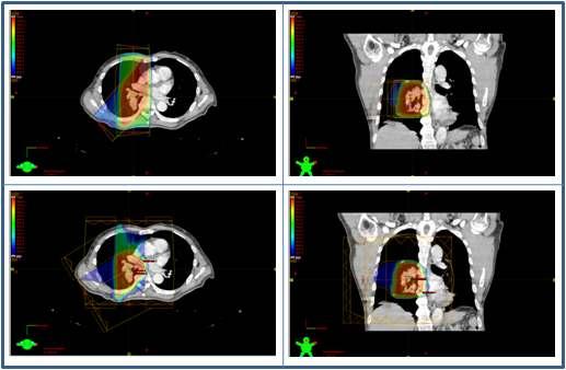 lung 환자의 x-ray 및 양성자 치료 plan의 예