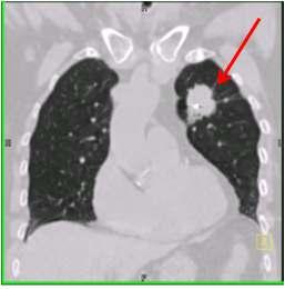 lung cancer의 coronal 영상