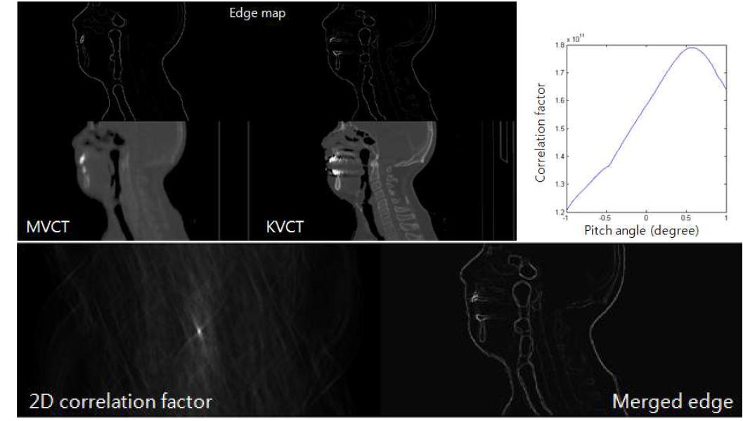 각 CT 데이터의 sagittal 영상과 추출된 경계치와 이를 이용해서 구한 이차원 상호연관인자 그림과 이를 토대로 정합한 경계치 그림이다.