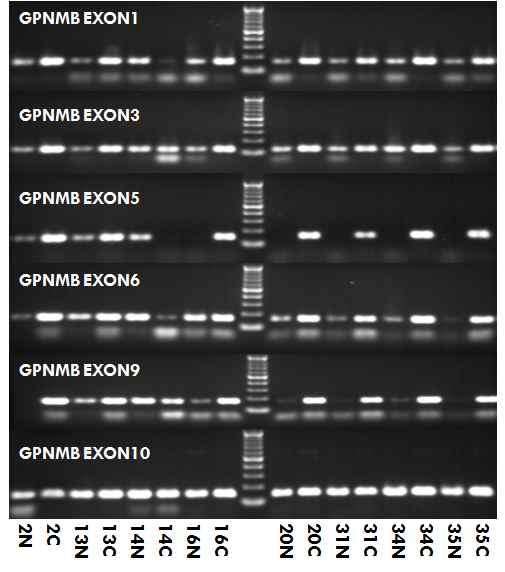 GPNMB의 splice variant를 validation하기 위한 stomach cancer patient의 exon specific RT-PCR.